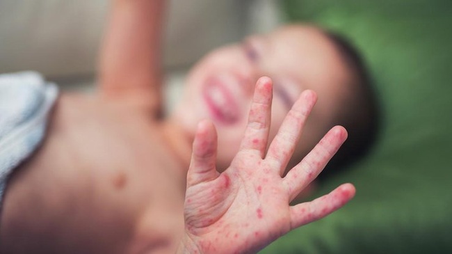В Одессе за минувшую неделю заболеваемость корью у детей снизилась на 40%