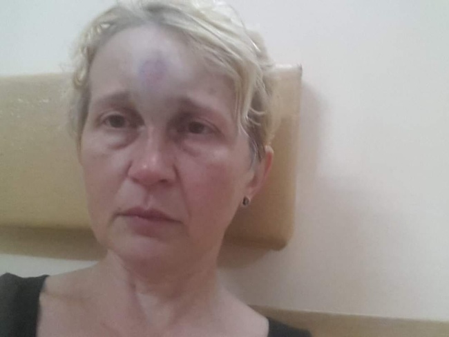 Поліція припинила шукати замовників нападу на одеську активістку