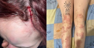 Кидалась у бійку: в поліції прокоментували інцидент з побиттям дівчини милицями в центрі Одеси