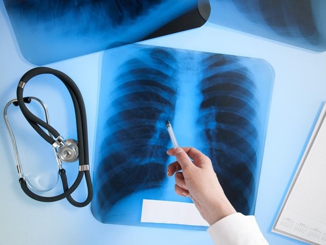 Одесским врачам заплатили 420 тысяч за обнаруженные случаи заболевания туберкулезом в 2017 году